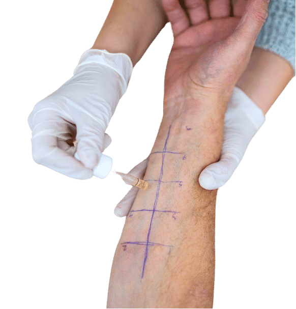 Médico realizando unas pruebas cutáneas de alergia, en el brazo de una paciente